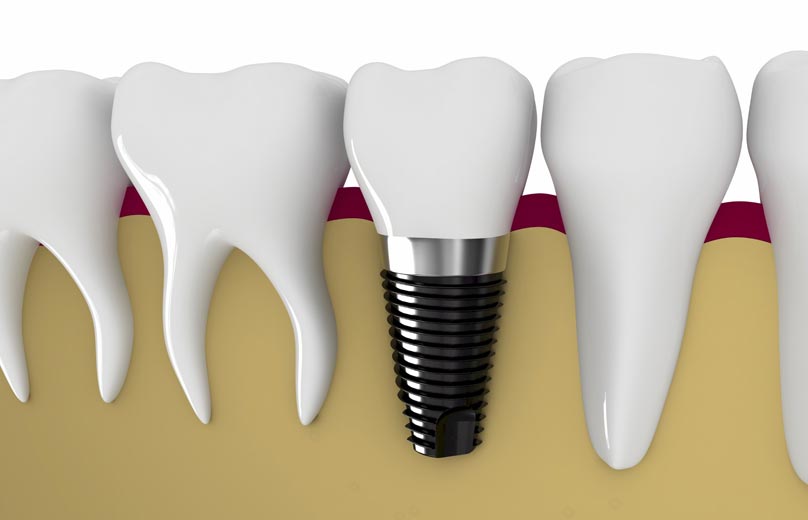 dental implants